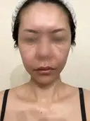 脂肪吸引（顔） / 切開リフト / 脂肪注入（輪郭） 牧野美容クリニック DAY 441 サムネイル用