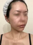 脂肪吸引（顔） / 切開リフト / 脂肪注入（輪郭） 牧野美容クリニック DAY 441 サムネイル用