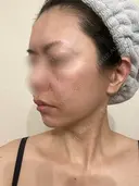 脂肪吸引（顔） / 切開リフト / 脂肪注入（輪郭） 牧野美容クリニック DAY 441 サムネイル用