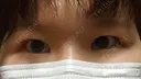 二重埋没 / 上まぶたの脂肪取り 東京イセアクリニック DAY 42 サムネイル用