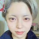 ヒアルロン酸注入（涙袋） フィラークリニック 大阪心斎橋院 DAY 20 サムネイル用