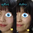 切開リフト LIKI CLINIC KOBE DAY 25 サムネイル用