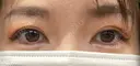 目頭切開 目白ポセンシアクリニック DAY 18 サムネイル用
