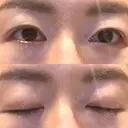 二重切開 城本クリニック 長崎院 DAY 179 サムネイル用