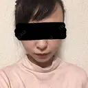 脂肪吸引（顔） / その他（輪郭） / 脂肪注入（輪郭） ヴィヴェンシアクリニック DAY 77 サムネイル用