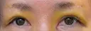 眉下切開 松下皮フ形成外科 DAY 5 サムネイル用