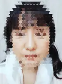 鼻尖形成（切開） / 鼻尖縮小 / ヒアルロン酸注入（鼻） 東京形成美容外科 船橋院 DAY 62 サムネイル用