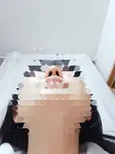 鼻尖形成（切開） / 鼻尖縮小 / ヒアルロン酸注入（鼻） 東京形成美容外科 船橋院 DAY 62 サムネイル用