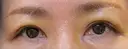 眉下切開 松下皮フ形成外科 DAY 6 サムネイル用