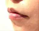 ヒアルロン酸注入（唇） / ボトックス（口角） 韓国みにょんクリニック DAY 4 サムネイル用