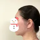 脂肪吸引（顔） / 切開リフト / PRP皮膚再生療法 湘南美容クリニック 新宿本院 DAY 61 サムネイル用