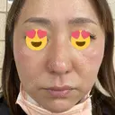 その他（肌） CHRISTINA CLINIC 銀座 DAY 0 サムネイル用