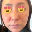 その他（肌） CHRISTINA CLINIC 銀座 DAY 0 サムネイル用