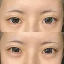 ヒアルロン酸注入（涙袋） フィラークリニック 大阪心斎橋院 DAY 35 サムネイル用