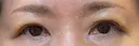 眉下切開 松下皮フ形成外科 DAY 8 サムネイル用