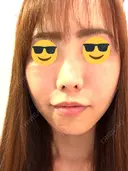ヒアルロン酸注入（唇） / ボトックス（口角） 韓国みにょんクリニック DAY 7 サムネイル用