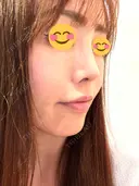 ヒアルロン酸注入（唇） / ボトックス（口角） 韓国みにょんクリニック DAY 7 サムネイル用