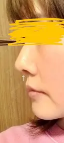 軟骨移植 LIKI CLINIC KOBE AFTER サムネイル用