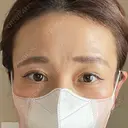 二重切開 / 眼瞼下垂（切開） 湘南美容クリニック Regno 銀座院 DAY 37 サムネイル用