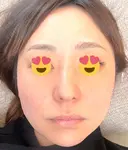 その他（肌） CHRISTINA CLINIC 銀座 DAY 2 サムネイル用