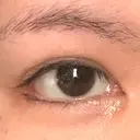 目頭切開 / 目尻切開 / 目尻靭帯移動 FROM B整形外科 (旧バウム整形外科) DAY 44 サムネイル用