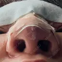 隆鼻術 / 鼻尖形成（切開） / 軟骨移植 白山クリニック 大分 DAY 1 サムネイル用