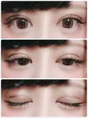 二重切開 / 目頭切開 / ヒアルロン酸注入（涙袋） FROM B整形外科 (旧バウム整形外科) DAY 33 サムネイル用
