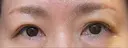 眉下切開 松下皮フ形成外科 DAY 11 サムネイル用