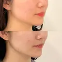 糸リフト / バッカルファット除去 / 脂肪吸引（顔） / 脂肪吸引（脚） / 脂肪吸引（お尻） / インディバ（お腹） 藤・ナチュレ美容クリニック 恵比寿院 DAY 112 サムネイル用