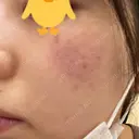レーザートーニング（美白・肝斑） 渋谷美容外科クリニック 池袋院 AFTER サムネイル用