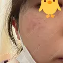 レーザートーニング（美白・肝斑） 渋谷美容外科クリニック 池袋院 DAY 28 サムネイル用
