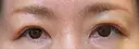 眉下切開 松下皮フ形成外科 DAY 12 サムネイル用