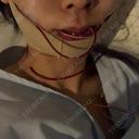 骨切り（あご） / 骨削り（エラ） リラ・クラニオフェイシャル・クリニック 大阪院 DAY 0 サムネイル用