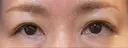 眉下切開 松下皮フ形成外科 DAY 14 サムネイル用