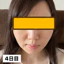 糸リフト / ヒアルロン酸注入（頬） EMMA CLINIC（エマクリニック） DAY 4 サムネイル用