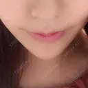 ヒアルロン酸注入（あご） / ボトックス（エラ・小顔） / 脂肪溶解注射（顔） 品川スキンクリニック神戸院（※品川美容外科提携） DAY 14 サムネイル用