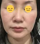 糸リフト / 脂肪吸引（顔） / ボトックス（エラ・小顔） 銀座マイアミ美容外科 AFTER サムネイル用