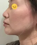 糸リフト / 脂肪吸引（顔） / ボトックス（エラ・小顔） 銀座マイアミ美容外科 DAY 26 サムネイル用