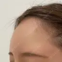 額を丸く / ヒアルロン酸注入（額） 藤・ナチュレ美容クリニック 恵比寿院 AFTER サムネイル用