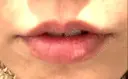 ヒアルロン酸注入（唇） / ボトックス（口角） 韓国みにょんクリニック AFTER サムネイル用