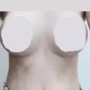 豊胸（シリコンバッグ） ジョウクリニック 那覇院 DAY 10 サムネイル用