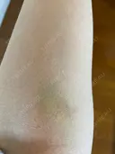 美容点滴・美容注射（疲労回復） シンデレラ＆ダヴィンチクリニック AFTER サムネイル用