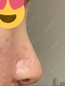 隆鼻術 / 鼻尖形成（切開） / 軟骨移植 白山クリニック 大分 DAY 9 サムネイル用