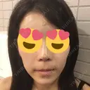 スレッドノーズ / ヒアルロン酸注入（鼻） / ヒアルロン酸注入（あご） / ヒアルロン酸注入（額） キップン整形外科 DAY 2 サムネイル用