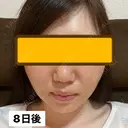 糸リフト / ヒアルロン酸注入（頬） EMMA CLINIC（エマクリニック） DAY 8 サムネイル用
