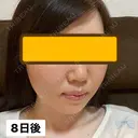 糸リフト / ヒアルロン酸注入（頬） EMMA CLINIC（エマクリニック） DAY 8 サムネイル用