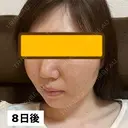 糸リフト / ヒアルロン酸注入（頬） EMMA CLINIC（エマクリニック） DAY 8 サムネイル用