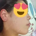 スレッドノーズ / ヒアルロン酸注入（鼻） / ヒアルロン酸注入（あご） / ヒアルロン酸注入（額） キップン整形外科 DAY 19 サムネイル用