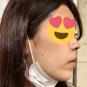 スレッドノーズ / ヒアルロン酸注入（鼻） / ヒアルロン酸注入（あご） / ヒアルロン酸注入（額） キップン整形外科 DAY 35 サムネイル用