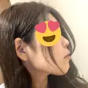 スレッドノーズ / ヒアルロン酸注入（鼻） / ヒアルロン酸注入（あご） / ヒアルロン酸注入（額） キップン整形外科 DAY 128 サムネイル用